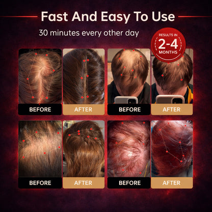 🔥Last Day — SAVE 80% OFF! Mresio® Red Light Cap — Regrow Hair, Reduce Shedding & One Purchase Protects the Whole Family for Years